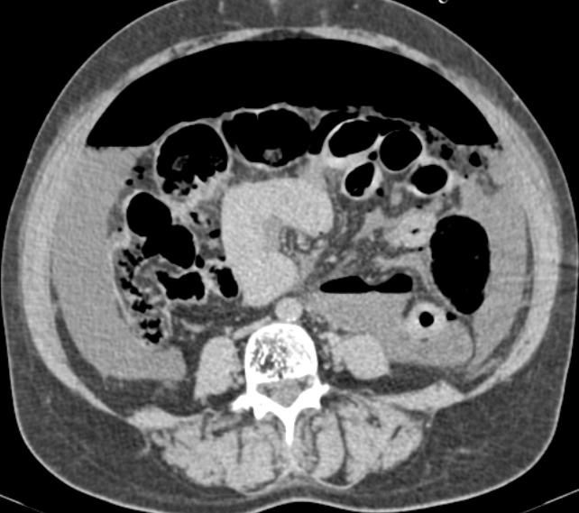 Corte axial de tomografia de abdome referente ao padrão perfurativo