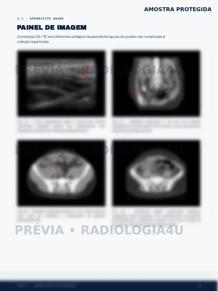 Prévia protegida do painel de imagens de apendicite aguda