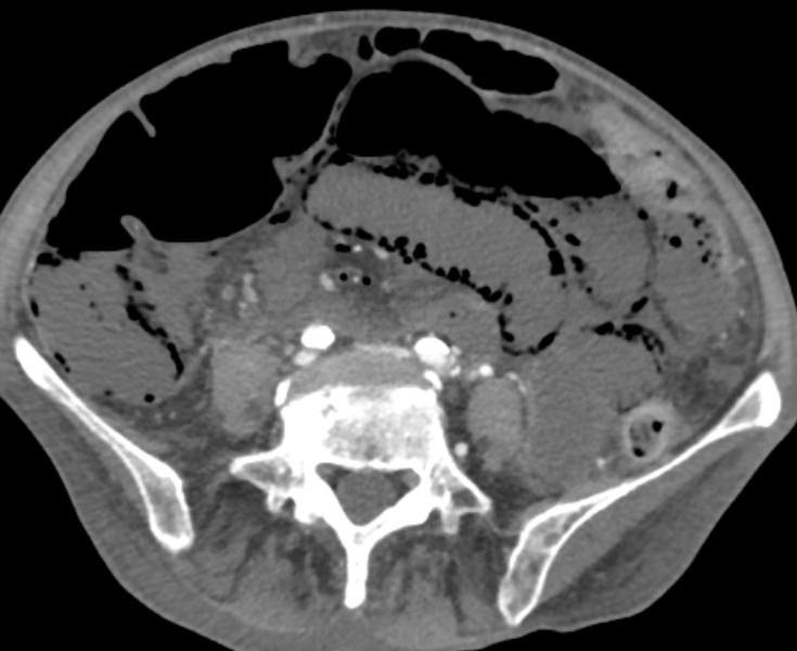 Corte axial de tomografia de abdome referente ao padrão vascular