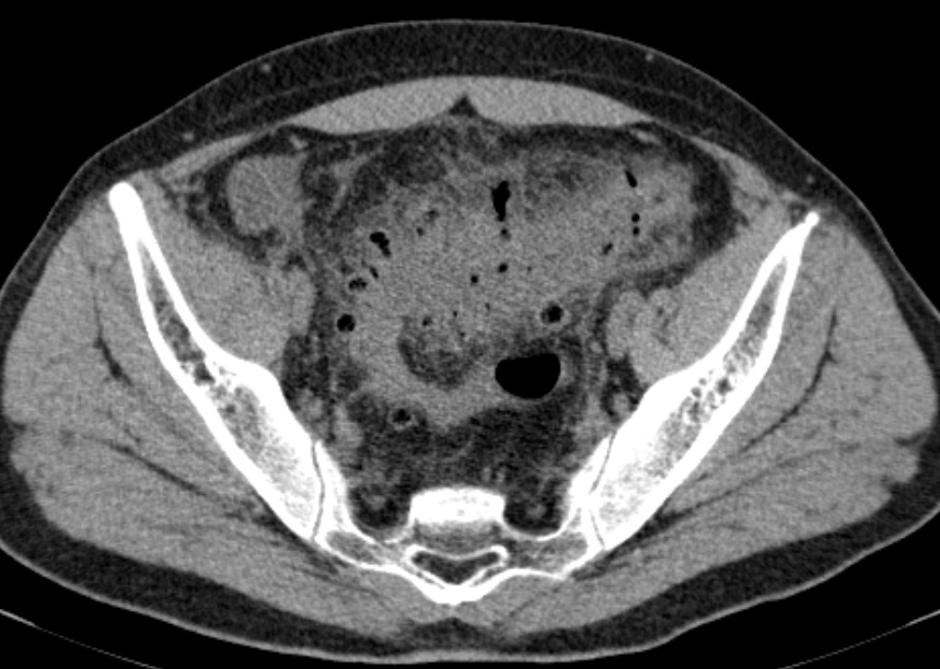 Corte axial de tomografia de abdome referente ao padrão inflamatório